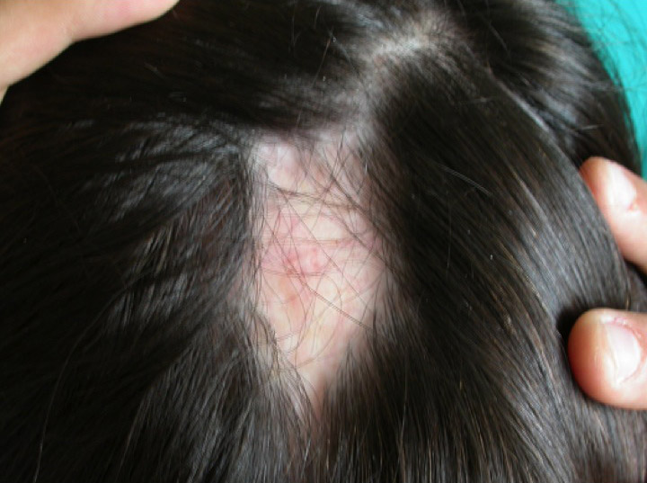 Malattia dei capelli Alopecia Areata