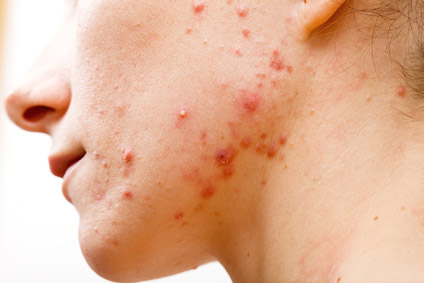 Cura dell'Acne