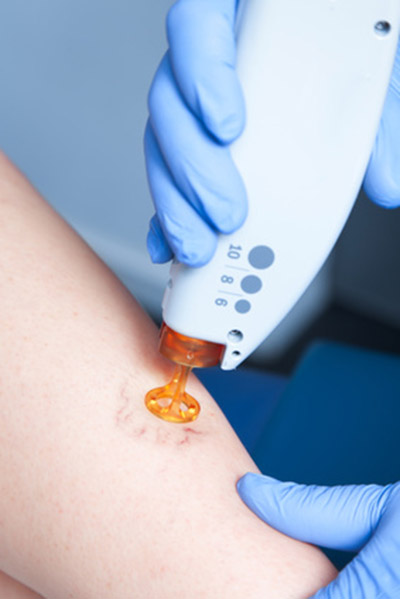 Cura Dermatologica: Laser contro i Capillari delle Gambe