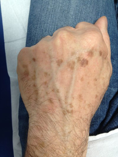 LaserTerapia sulle Macchie della Pelle