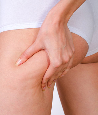 Trattamenti di medicina estetica per correggere la cellulite