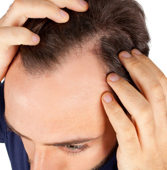 Malattia dei capelli Alopecia Androgenetica