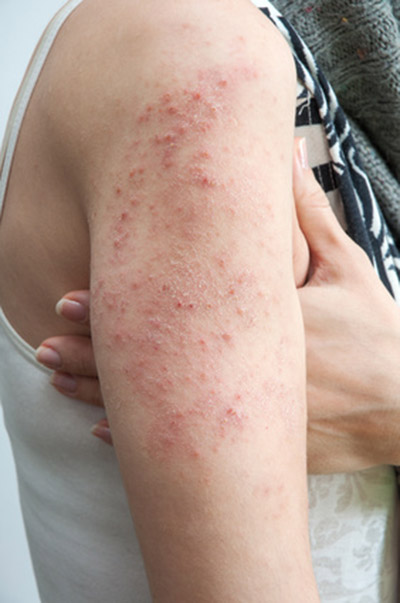 La Malattia dell'Eczema