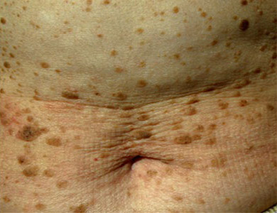 Malattia della pelle: la Cheratosi Seborroica