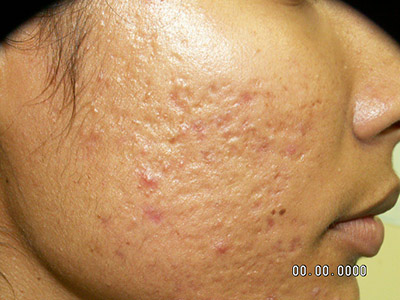 trattamento cicatrici acne